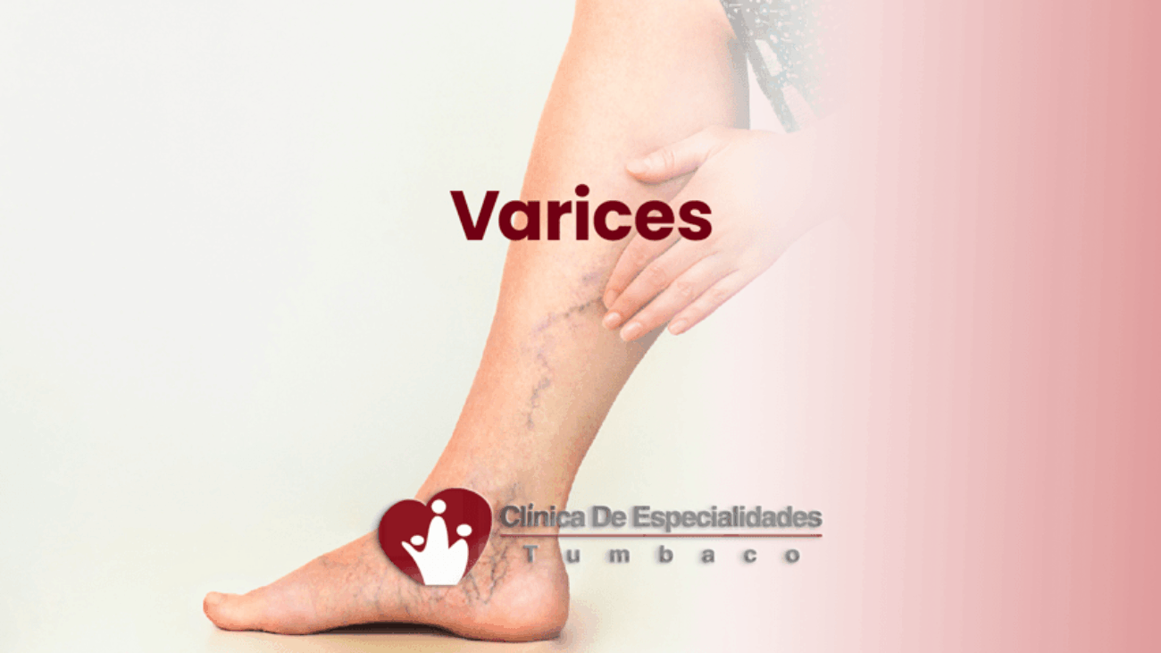 varices-en-tumbaco-quito-consejos